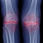 Artrosis de rodilla: descripción, causas, tipos, diagnóstico y tratamiento