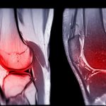 Condromalacia rotuliana: Una lesión común en la rodilla